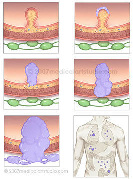 Polyp