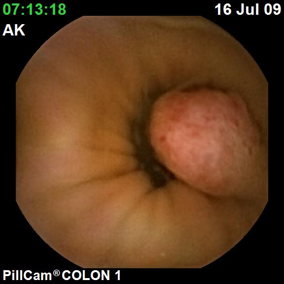 Az egyik polyp