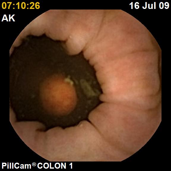A másik polyp